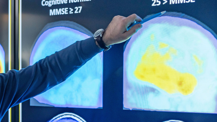 Identifican dos nuevos genes que aumentan el riesgo de desarrollar Alzheimer