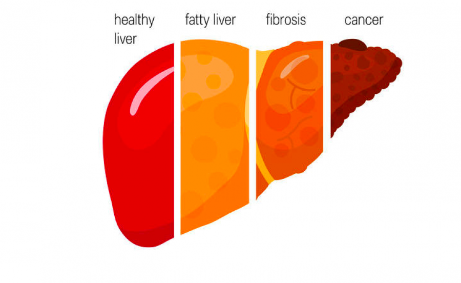 Esteatosis hepática metabólica: así es la enfermedad que sufre el 25 % de población