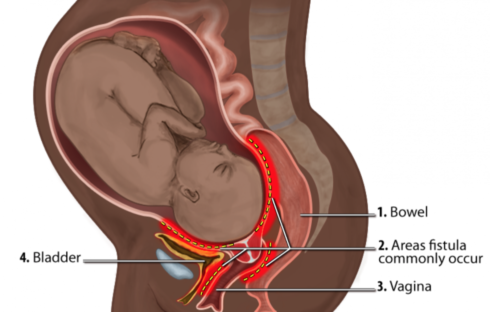 Fístula obstétrica