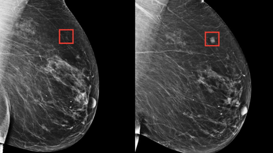 Las mamografías apoyadas por IA aumentan un 20% la detección del cáncer de mama