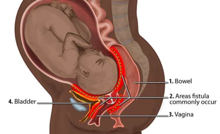 La fístula obstétrica, una lesión que afecta a mujeres en situación de pobreza