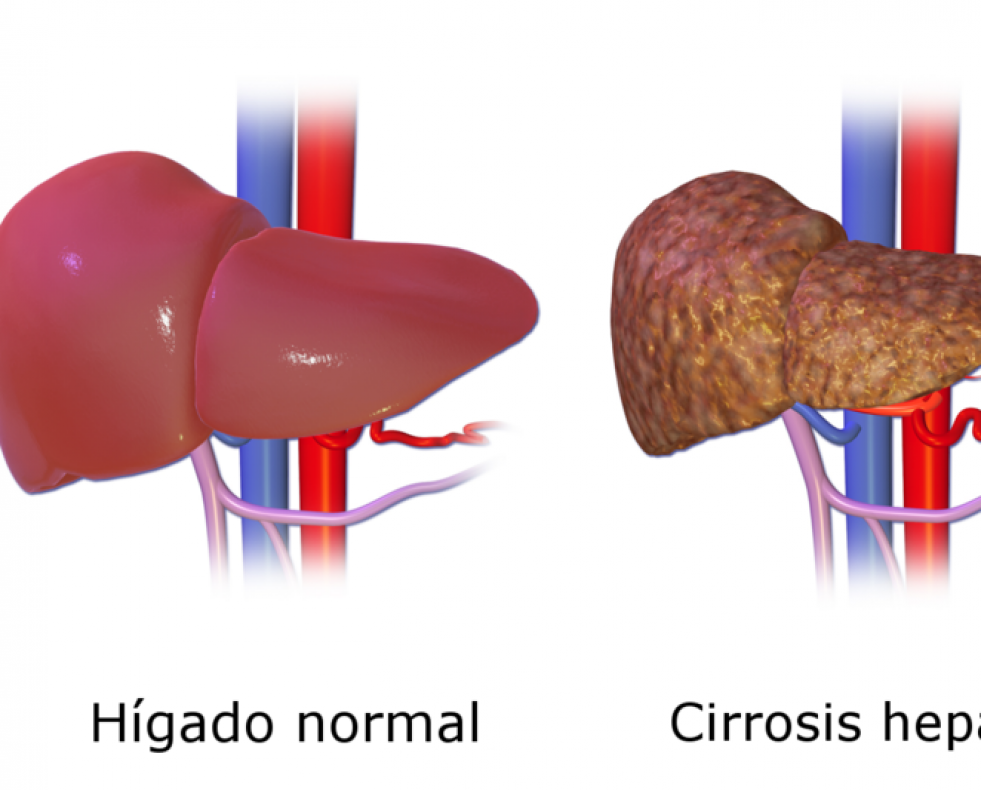 Cirrosis