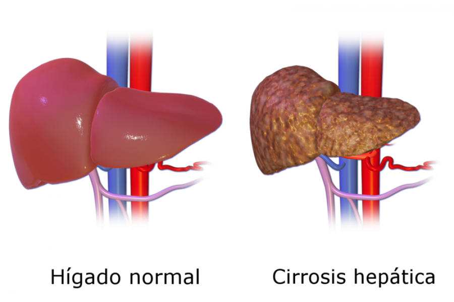 Reducir la fragilidad en la cirrosis: ejercicio en casa, aminoácidos y probióticos