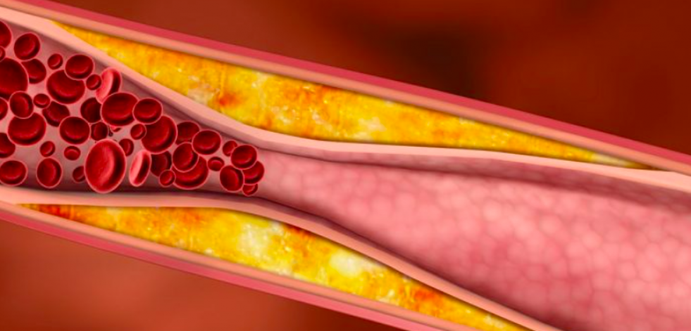 Hallan un mecanismo de aterosclerosis precoz en un síndrome de envejecimiento prematuro