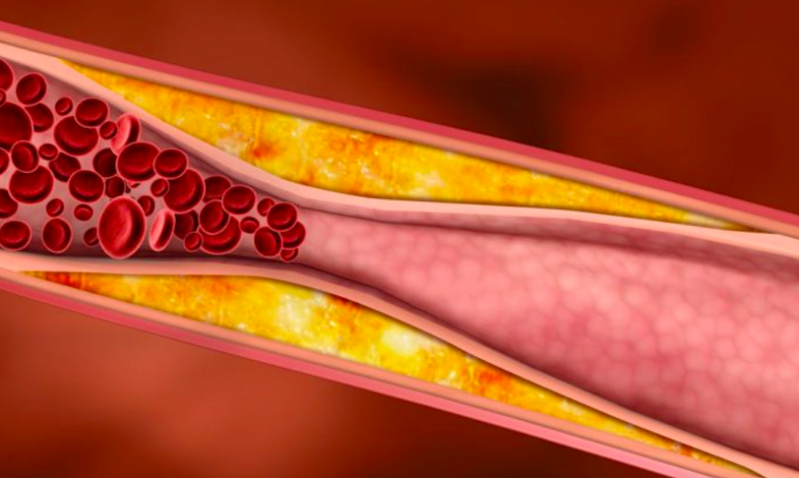 Hallan un mecanismo de aterosclerosis precoz en un síndrome de envejecimiento prematuro